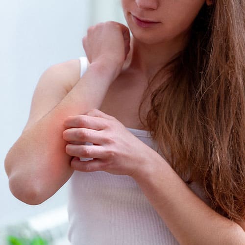 Allergic dermatitis Treatment