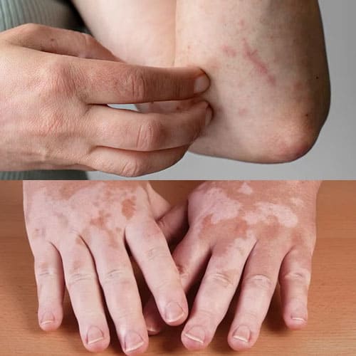 Auto Immune Disease Treatment