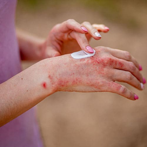 Eczema Treatment