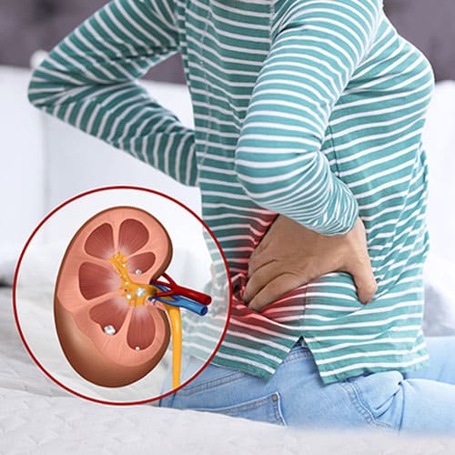 Kidney stone Treatment