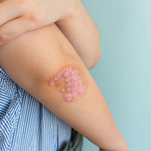 Psoriasis Treatment