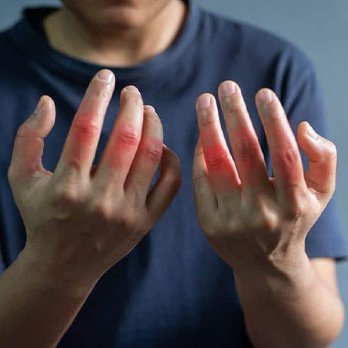 Rheumatic Arthritis Treatment