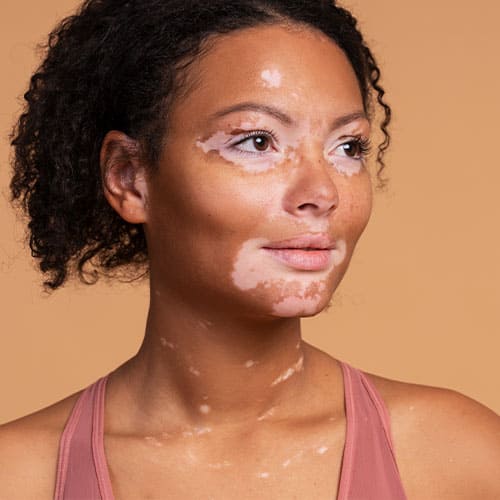 Vitiligo Treatment